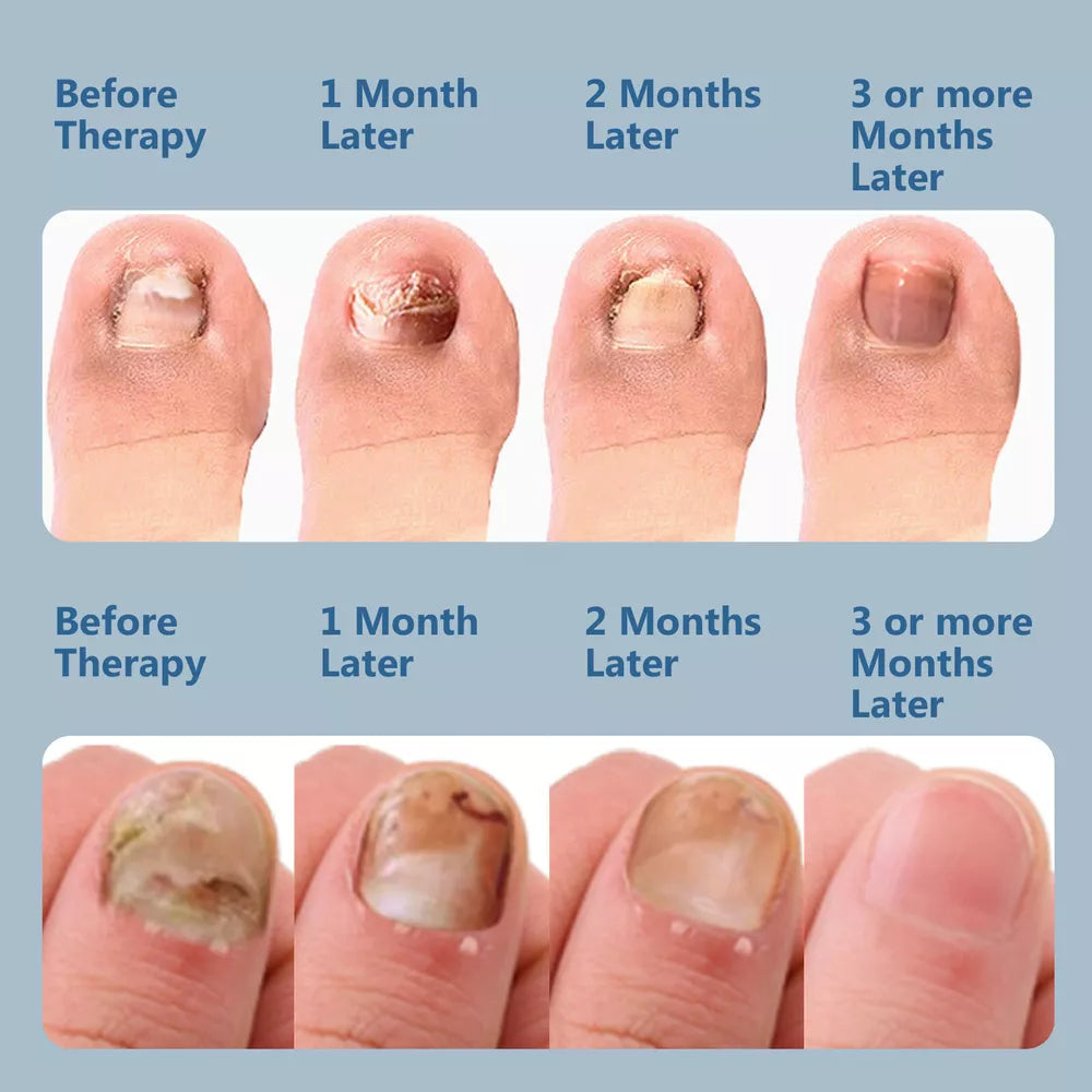 Nail Fungus Laser Treatment Device | Dual Wavelength Therapy 905nm & 470nm